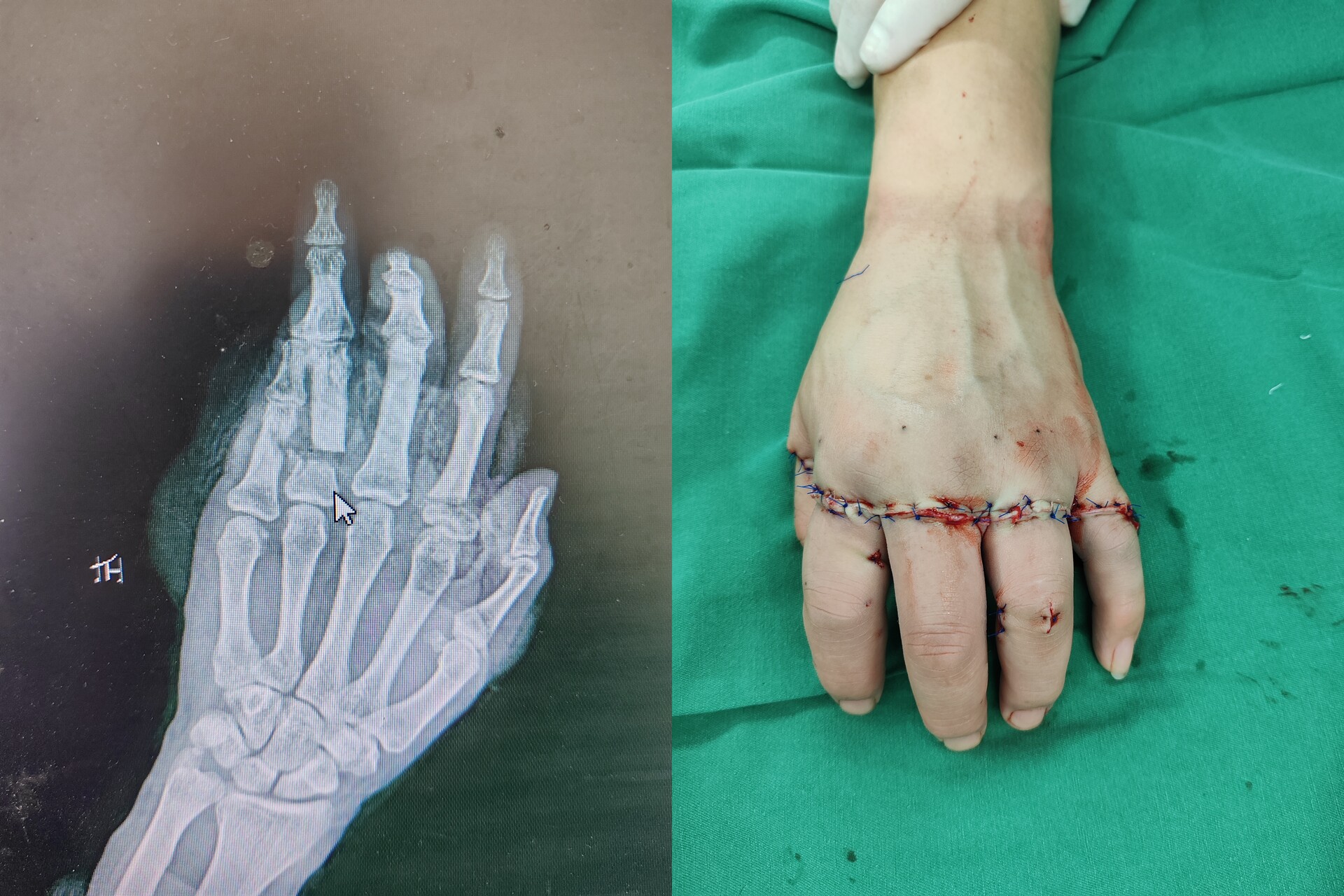 与时间赛跑！汨罗市人民医院成功再植男子完全离断三指